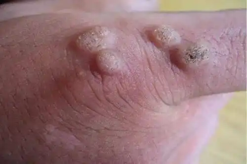 宝宝身上有这4种胎记或痣,要立刻就医!