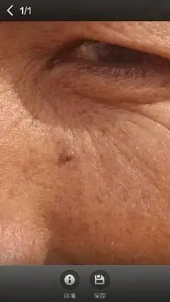 老爸脸上长了个肉疙瘩,不痛不痒的,是怎么