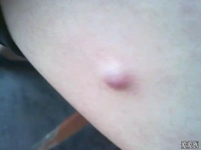 大腿内侧的肿物