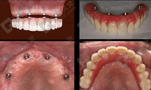 5万块钱能种植全口牙吗揭秘全口种植牙费用多少钱