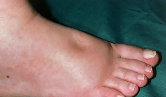 肾炎的危害有哪些盘点慢性肾炎的6大危害