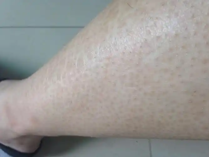 肚子的皮肤像鸡皮一样(肚子的皮肤像鸡皮一样怎么回事)