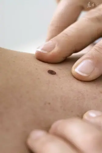 人身上的痣会发生恶变吗?警惕那些易被摩擦到的痣