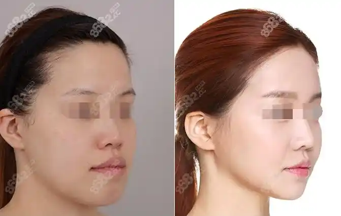 广州正颌手术做得比较好的医生里周会喜和杨小平怎么选