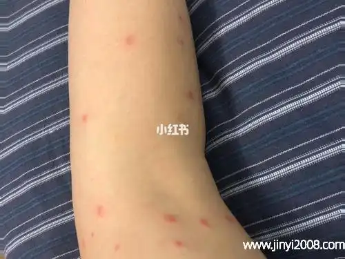 除螨喷雾喷了被子要洗吗怎么判断被螨虫咬了