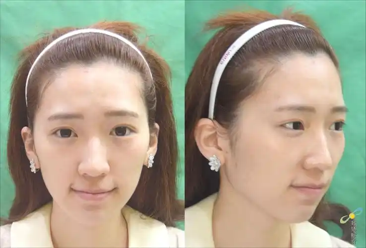 玻尿酸垫山根 - 南阳诊所