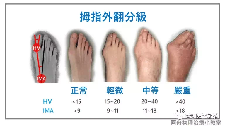 推荐几个拇趾外翻的矫正运动 - 好大夫在线