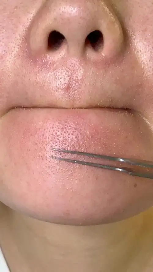 脸上粉刺黑头白头怎么处理