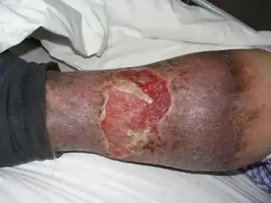 下肢深静脉血栓形成可能导致患者小腿外侧皮肤大面积发黑,发紫,局部有