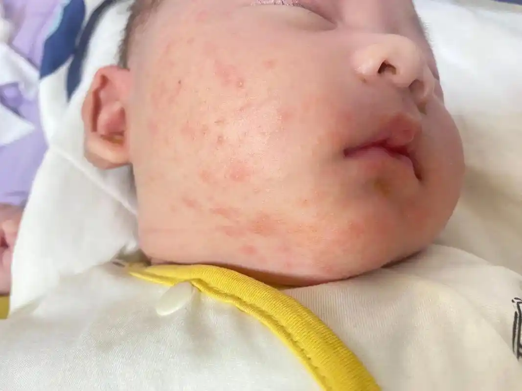 在和湿疹对抗的一个多月里,挂了皮肤科,儿科, - 抖音