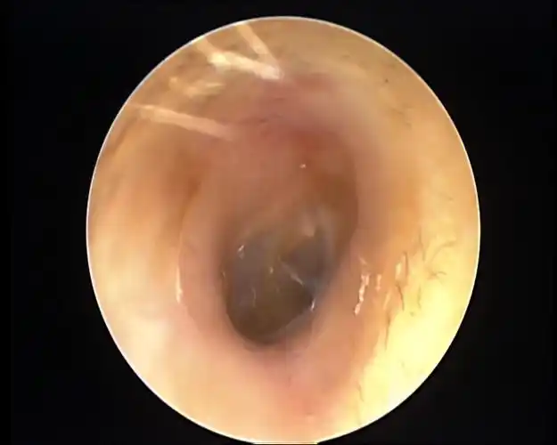 小伙享受了次掏耳朵服务,可怕一幕出现:耳朵里布满密密麻麻的