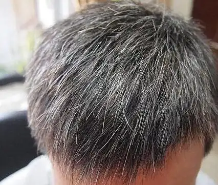 我才20岁就有白头发,到底哪里出了问题?