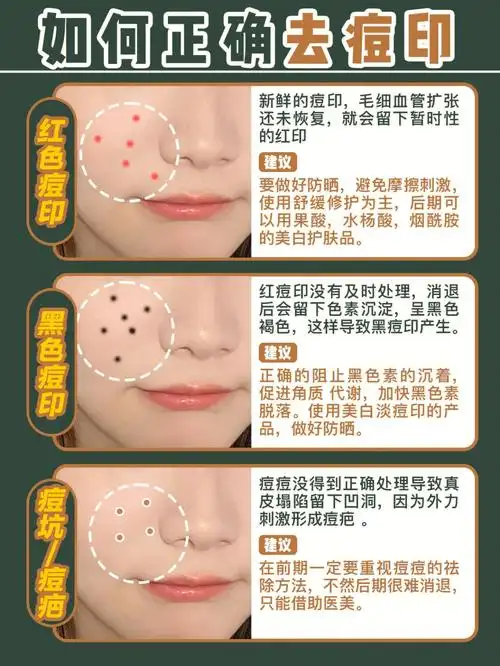 从高中开始就被痘印折磨到现在要说祛痘印我可太懂了!