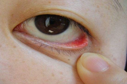 眼睛麦粒肿初期图片7
