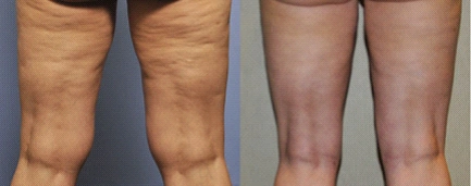 的抽吸,而且一次吸脂的量也都是有限制的,这样不会导致皮肤松弛的太多