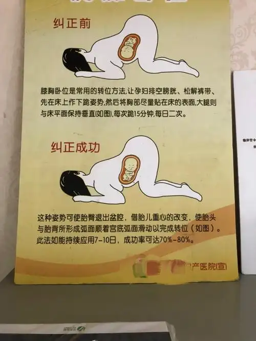 有没有臀位顺产的宝妈