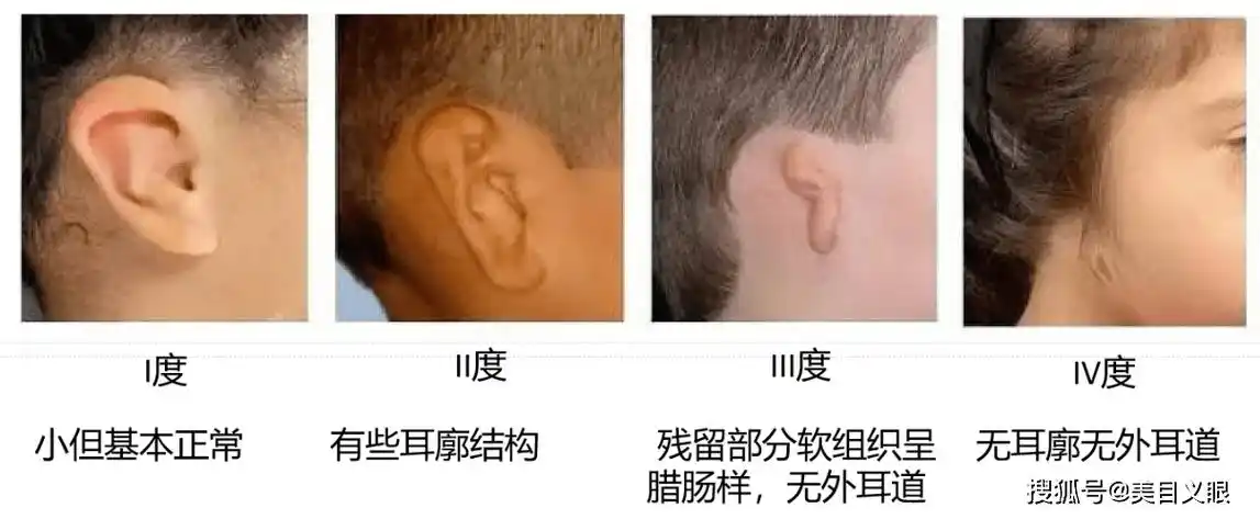 手术_耳朵_耳廓