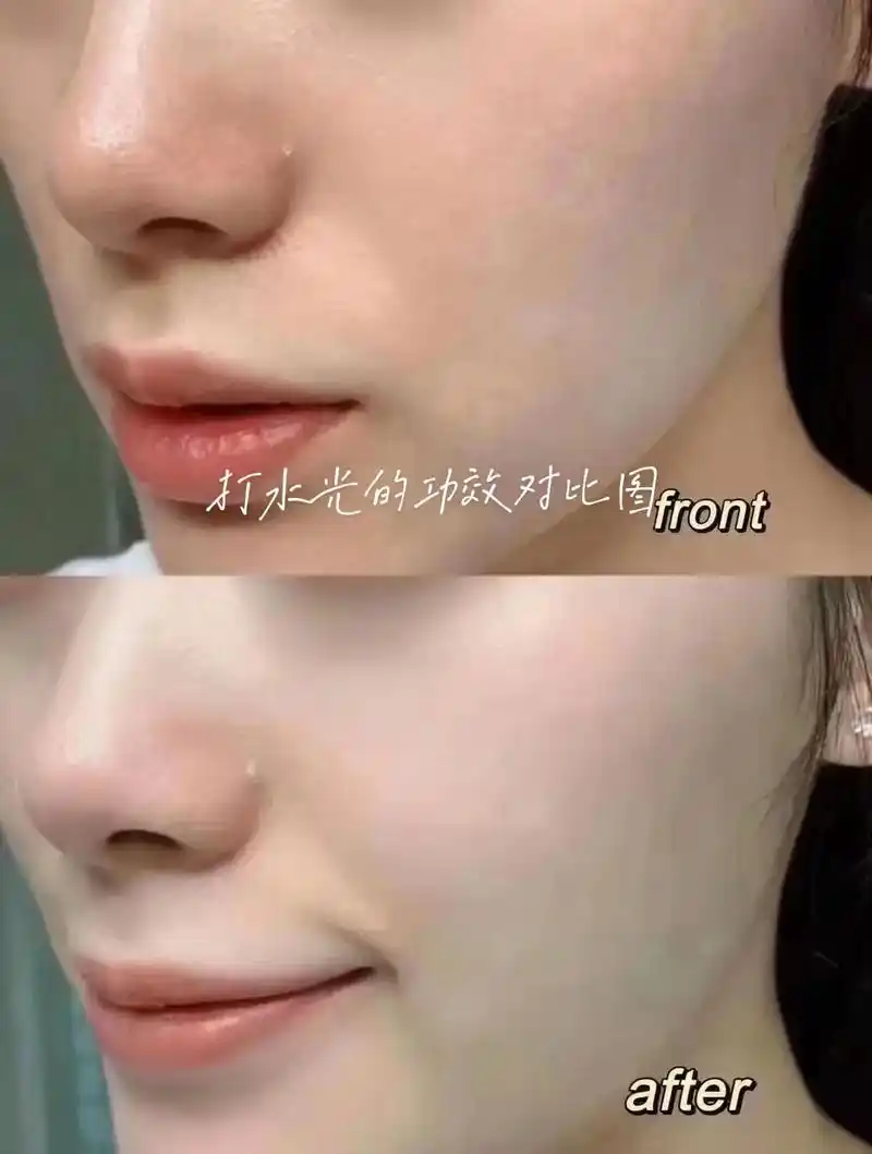 [太阳]水光针91|水光针功效:可以抗氧化,提亮肤色,淡化黑 - 抖音