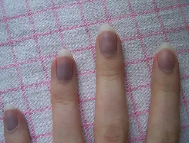 蓝指甲缺氧,青太过,为蓝,淤血,或心脏滞阻,是恶性病变指甲