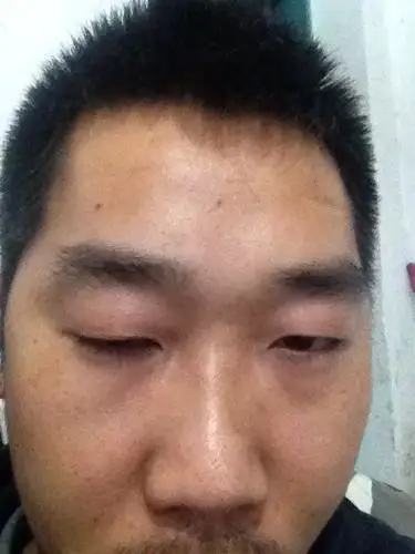 眼睛肌无力吃什么药