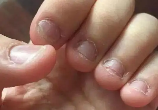 上小学了老是啃指甲怎么回事,怎样可以戒掉咬指甲?
