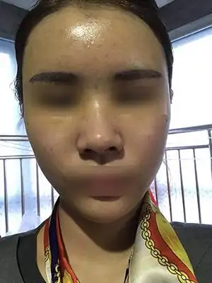 自体脂肪全脸填充失败了如何修复多久才能变平整