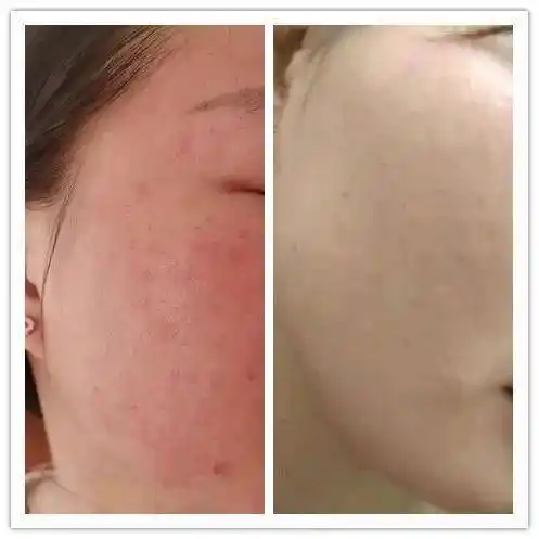 激光治疗红血丝有副作用吗?_肌肤_皮肤_工作