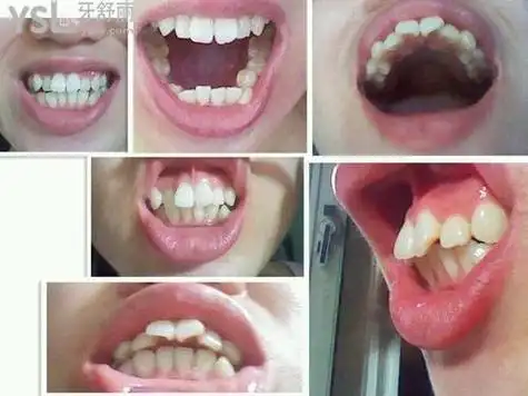 门牙两颗龅牙可以怎么改善?你要的答案都在这!