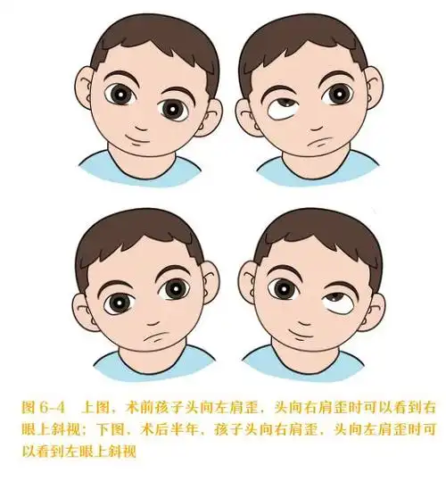 孩子总爱"歪头"卖萌,当心得了这种病!1个方法就能自测!