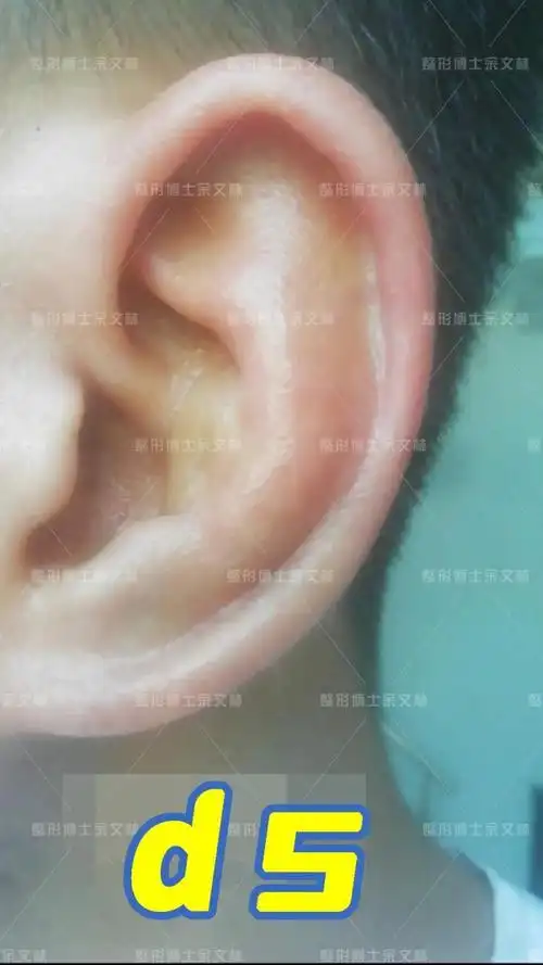这个反骨耳患者耳骨外翻严重他觉得不好看做手术修复了