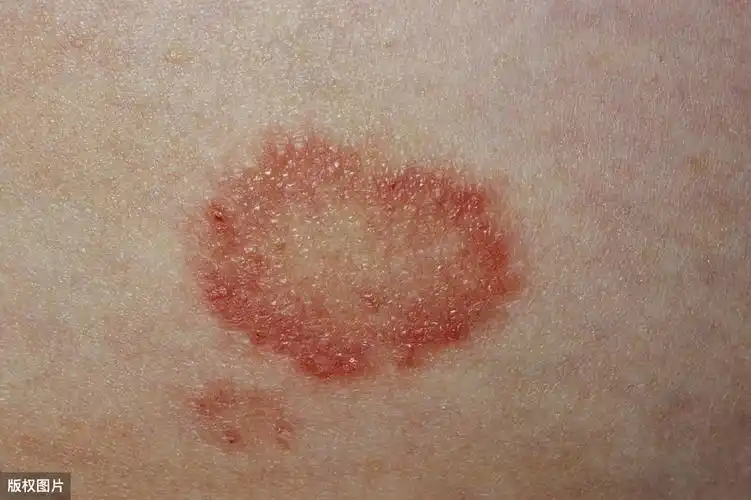 常见皮肤病问答#股癣和体癣(tinea cruris and tinea corporis)