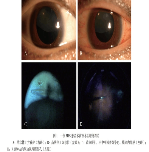 马凡综合征晶状体脱位伴孔源性视网膜脱离一例