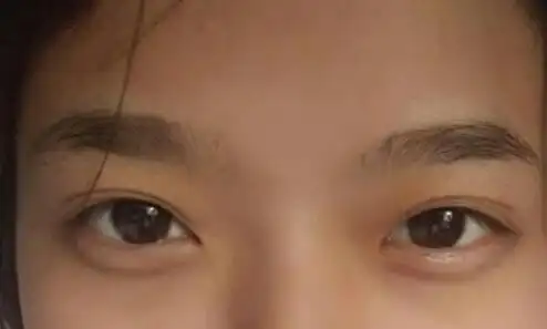 玻尿酸丰卧蚕帮你拥有真实的卧蚕