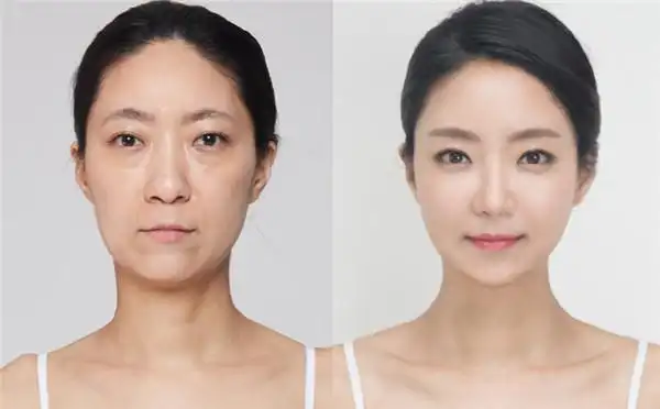 自体脂肪丰脸|诞生童颜女神