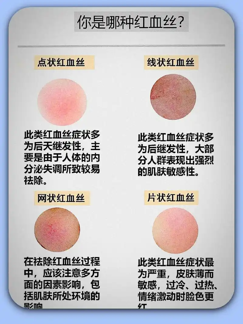 敏感肌必看!脸上有红血丝应该怎么办?有些敏感肌的姐妹脸上会 - 抖音