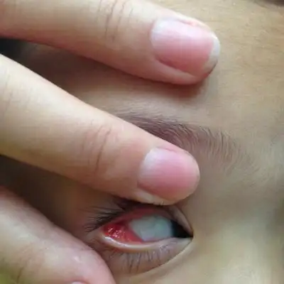 宝贝眼睑内长了两个包