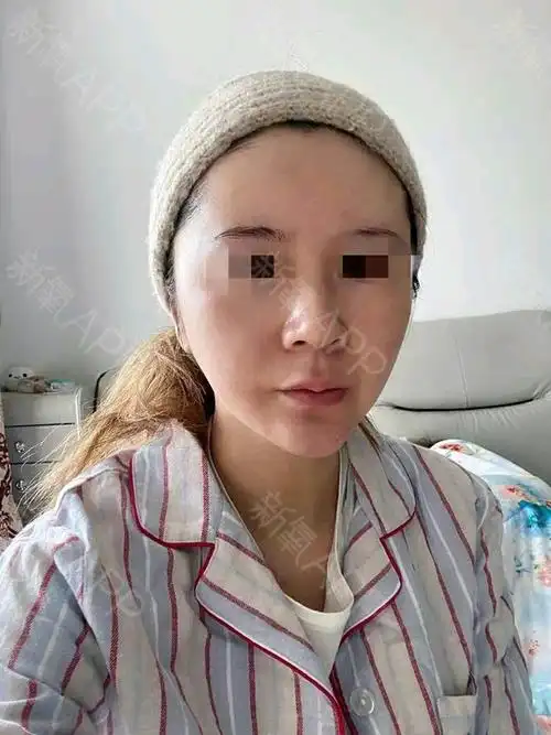拉皮手术提升好不好_效果图_莫文文拉皮手术提升术后第7天_新氧美容