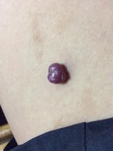 问:各位专家好,我大腿内侧皮肤表面凸起个东西,现在有黄豆粒大小.