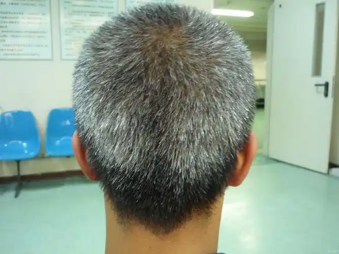 典型病例白发