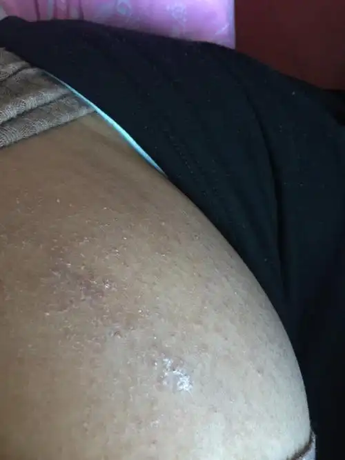 有得湿疹的宝妈进来