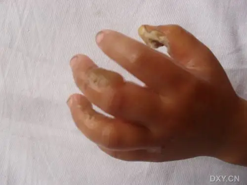 病例讨论 双手指三度电烧伤 [病例帖]