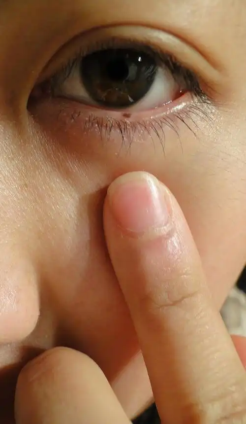 下眼睑长痣怎么办,求治疗方案