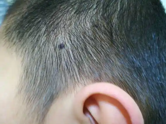 我儿子今年12岁了,脑袋长出2个黑点,小大一小,不痛不痒有凹凸感.