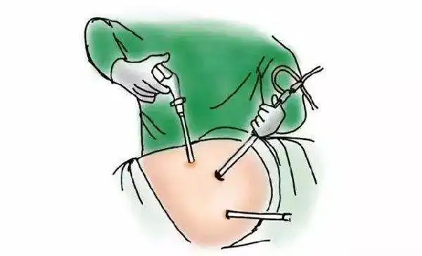 据介绍,腹腔镜胃癌根治术是一个高难度,高风险的手术.