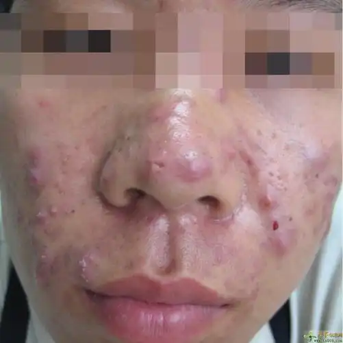 上海华山医院皮肤科李长恒教授怎么预约