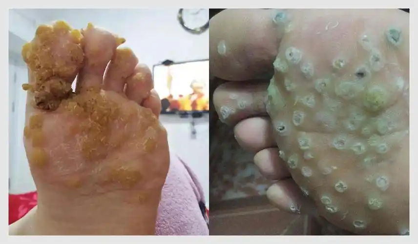 孙叔公干货40的人都弄错脚底的鸡眼原来是跖疣