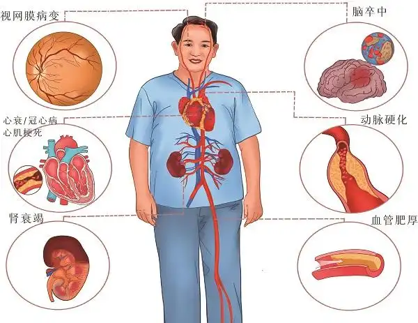 夏季血压波动老年人如何监测血压