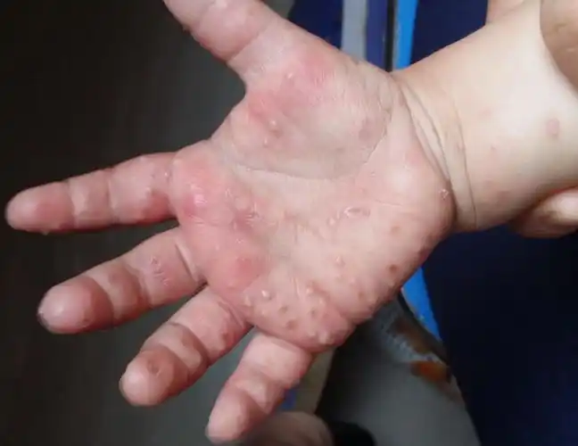 小孩皮肤病手和脚都长其他地方没有长