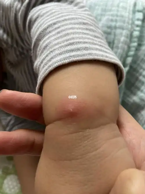 宝宝起火疖子(白头老)是怎么回事?