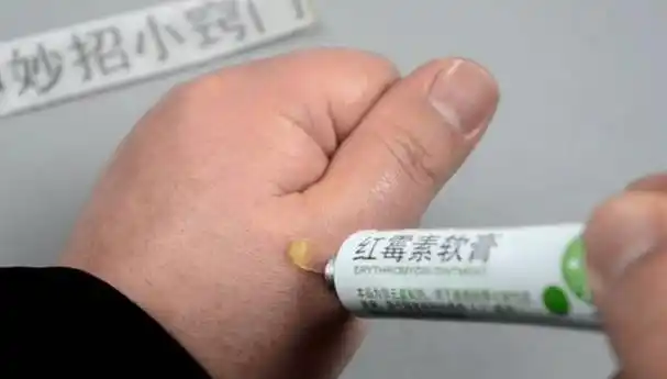 2块钱的红霉素软膏被称为"淡斑专家"?医生说出了答案和用法